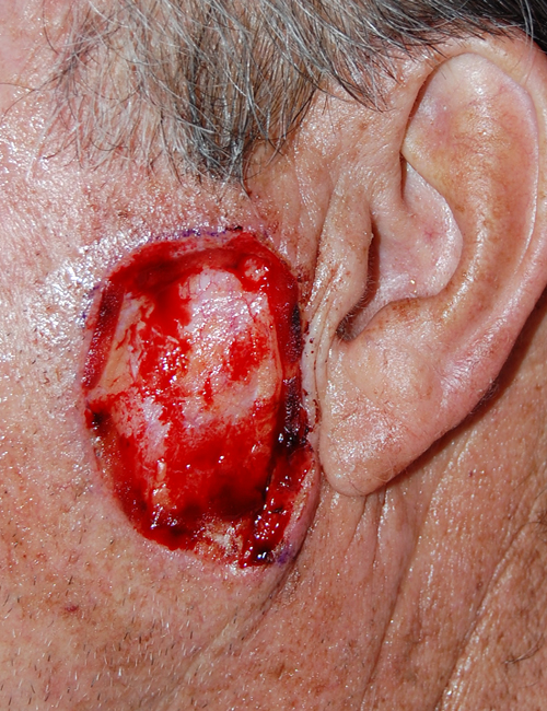 Before Mohs Cheek