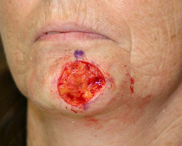 Before Mohs Chin