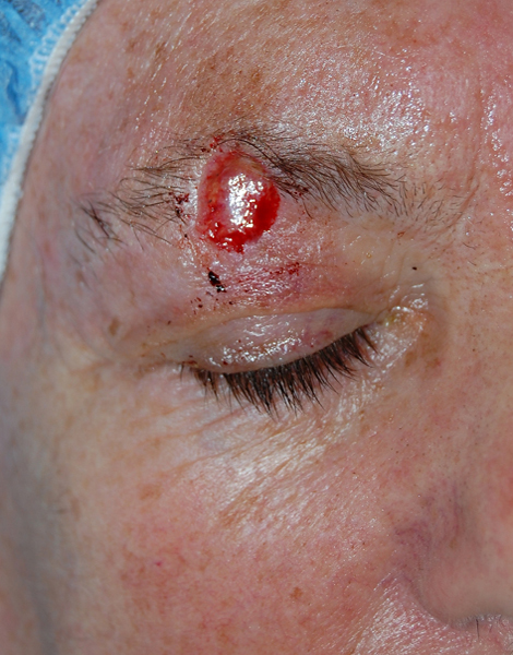 Before Mohs Eyebrow