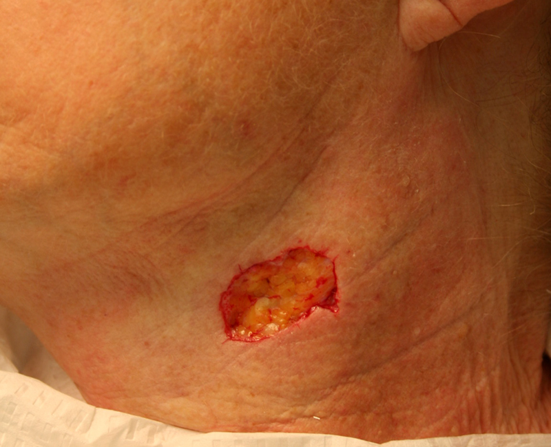 Before Mohs Neck
