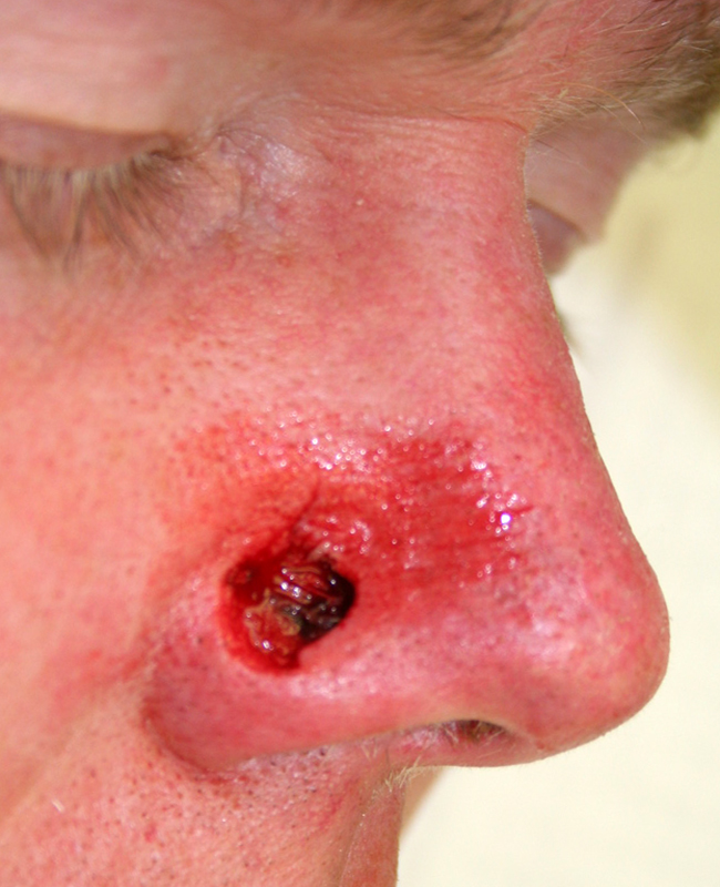 Before Mohs Nose