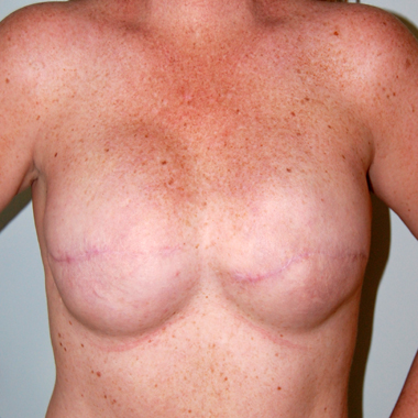 Before Nipple Reconstruction