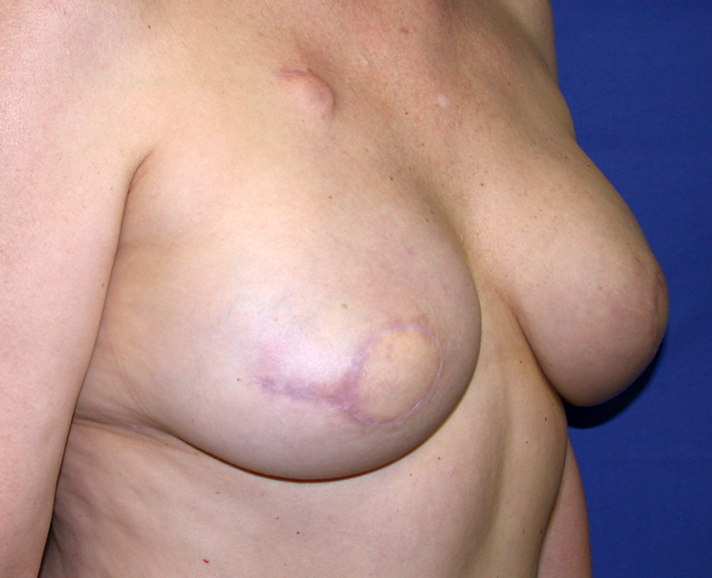 Before Nipple Reconstruction