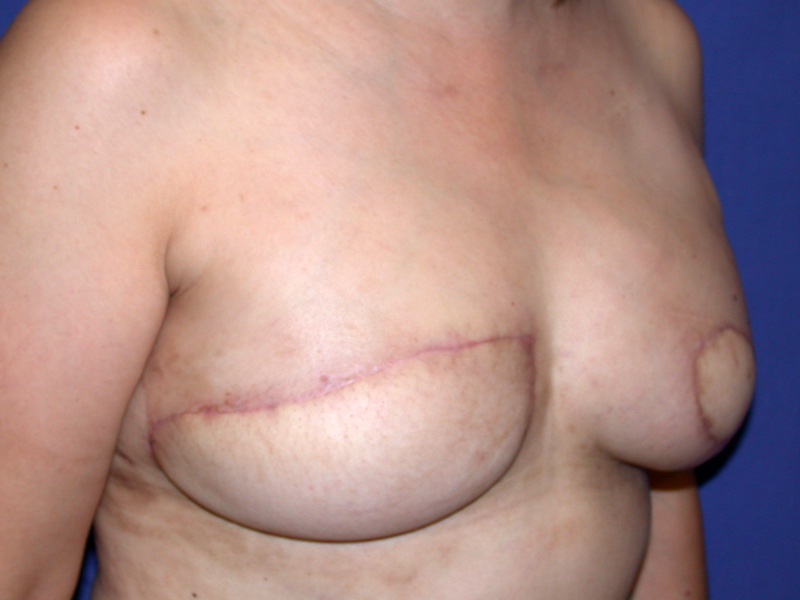 Before Nipple Reconstruction