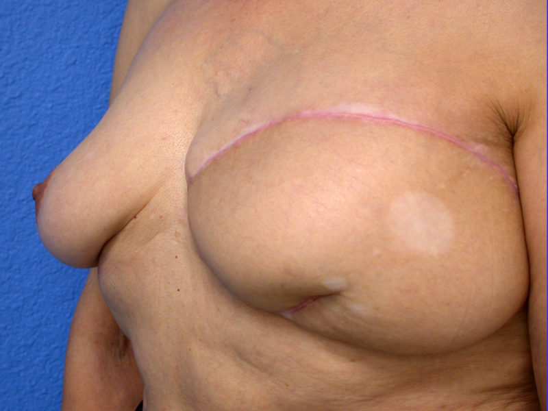 Before Nipple Reconstruction