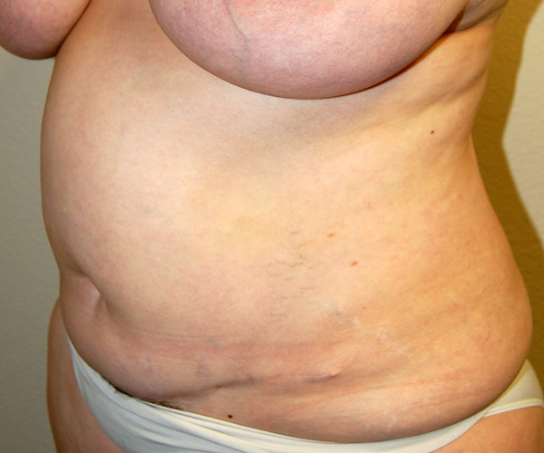 Before Abdominoplasty