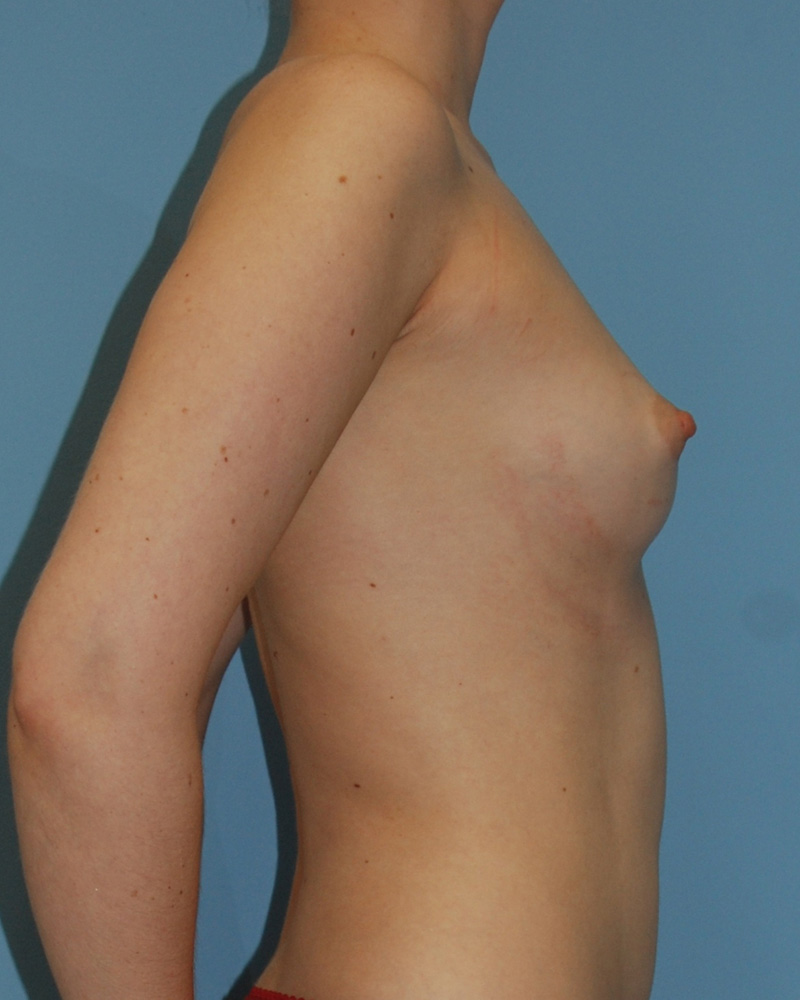 Before Breast Augmentation with Fat Grafting by Dr. Bermudez