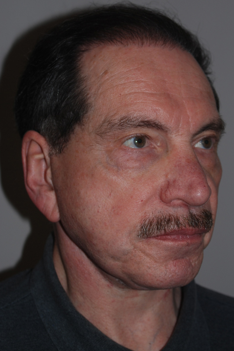 After Face Lift Surgery by Dr. Bermudez in San Francisco