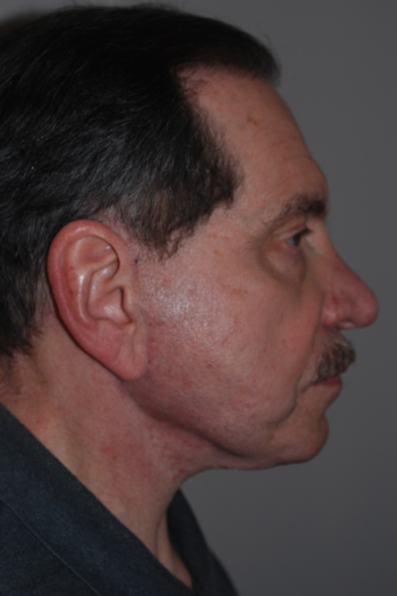 After Face Lift Surgery by Dr. Bermudez in San Francisco
