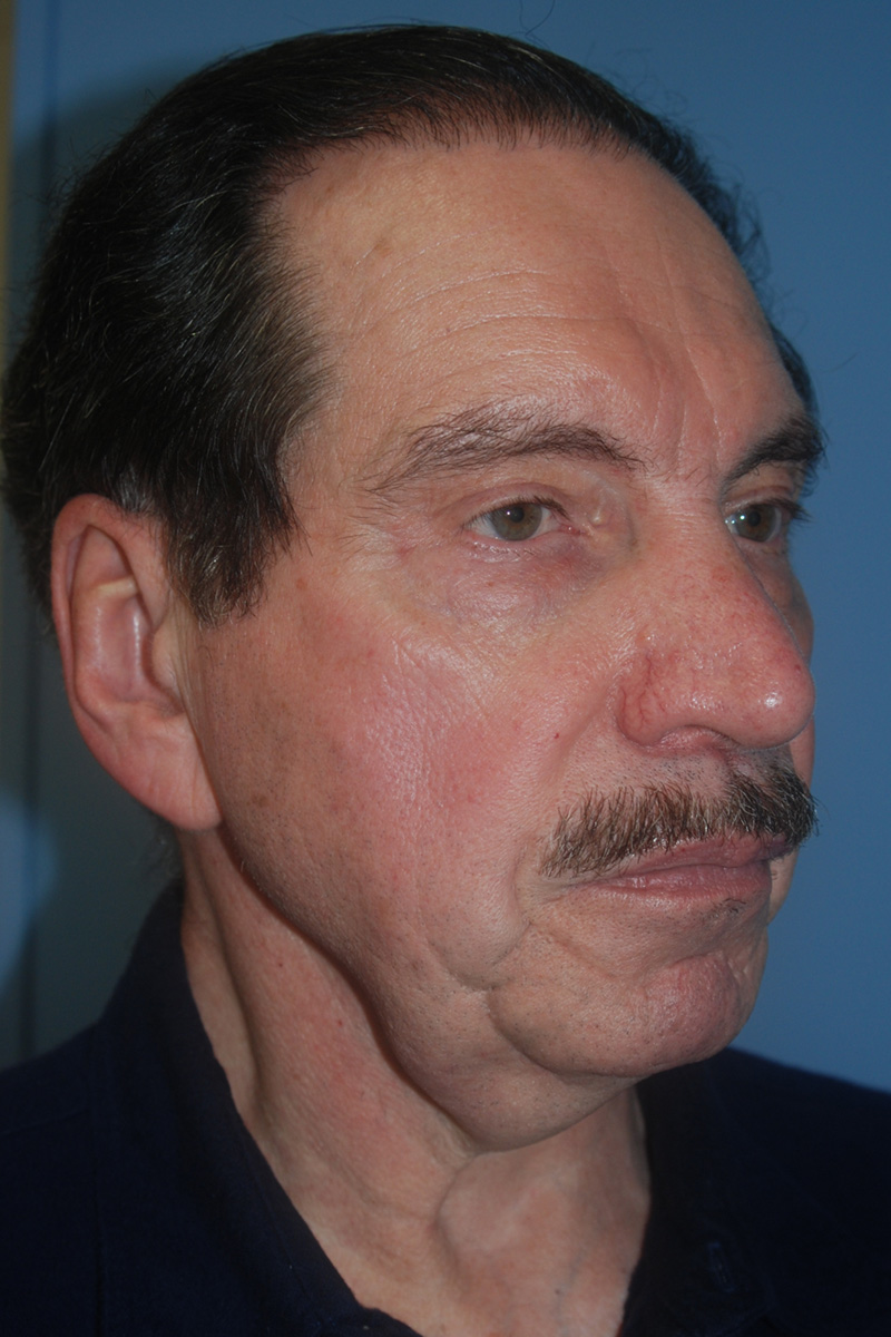 Before Face Lift Surgery by Dr. Bermudez in San Francisco