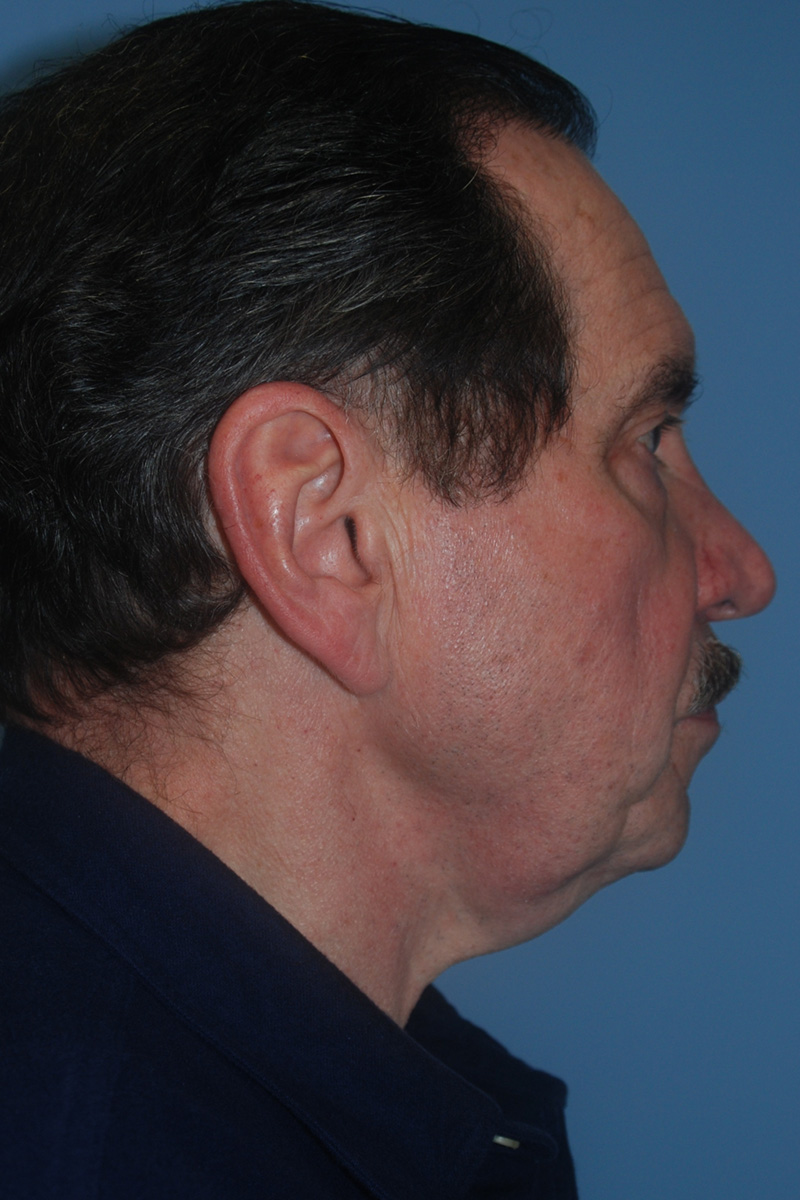 Before Face Lift Surgery by Dr. Bermudez in San Francisco