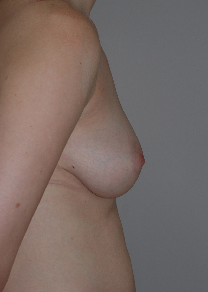 After Breast Augmentation with Fat Grafting by Dr. Bermudez
