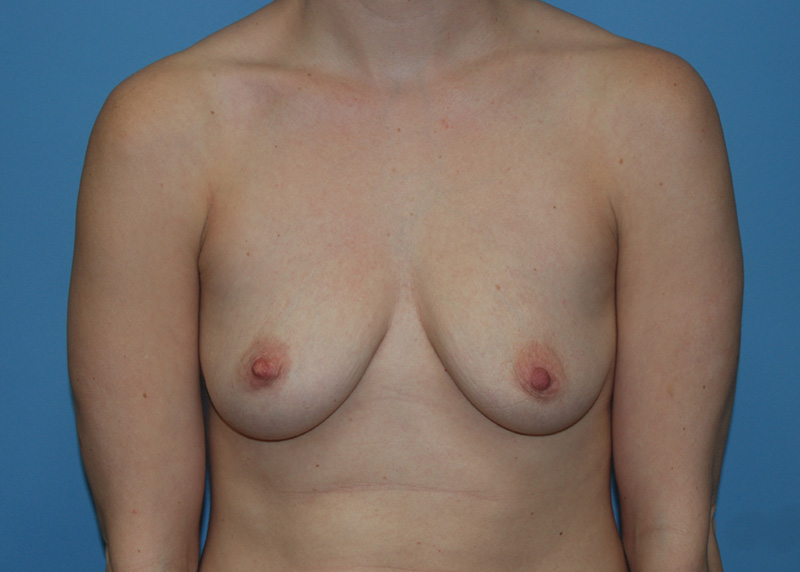 Before Breast Augmentation with Fat Grafting by Dr. Bermudez