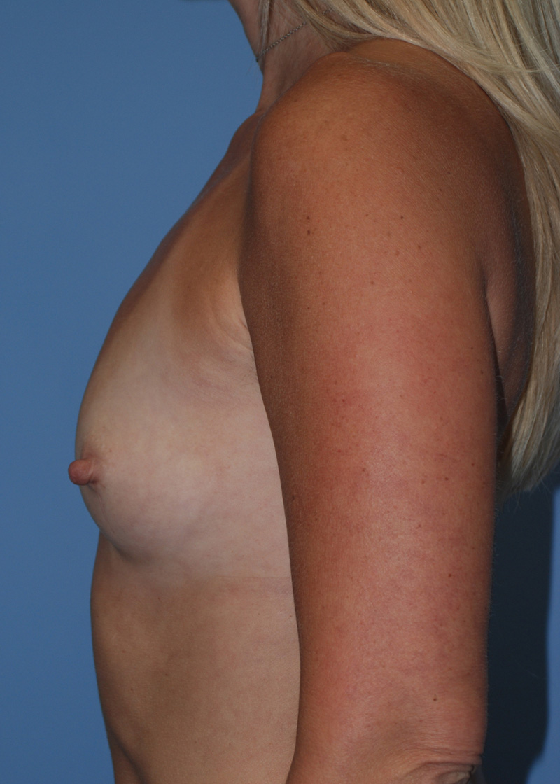 Before Breast Augmentation with Breast Implants by Dr. Bermudez