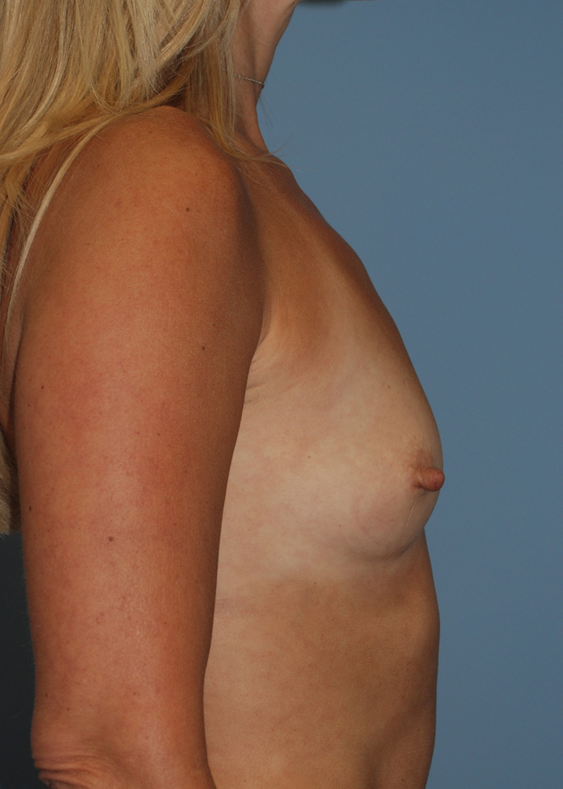 Before Breast Augmentation with Breast Implants by Dr. Bermudez
