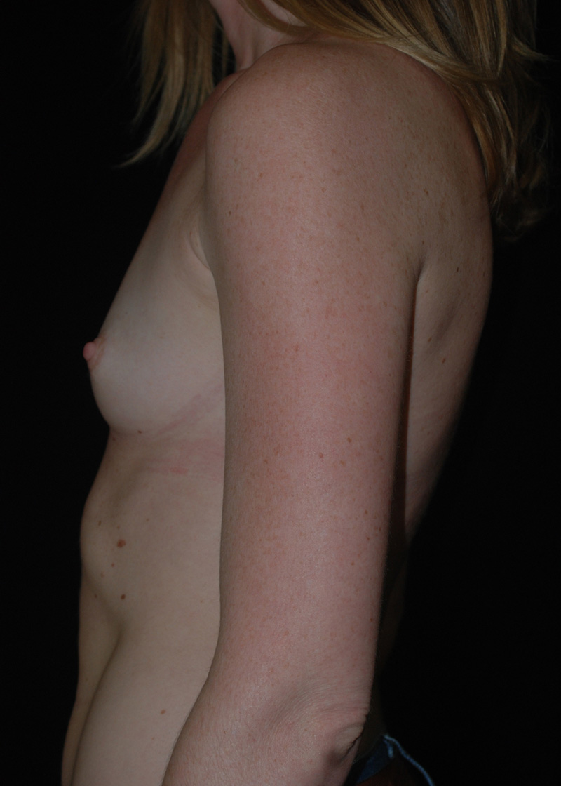 Before Breast Augmentation with Breast Implants by Dr. Bermudez