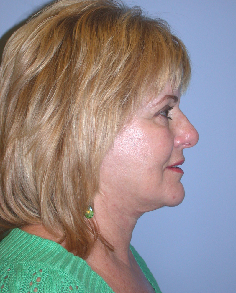 After Face Lift with Lip Filler by Dr. Bermudez in San Francisco