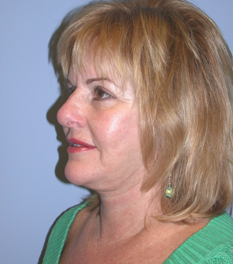 After Face Lift with Lip Filler by Dr. Bermudez in San Francisco