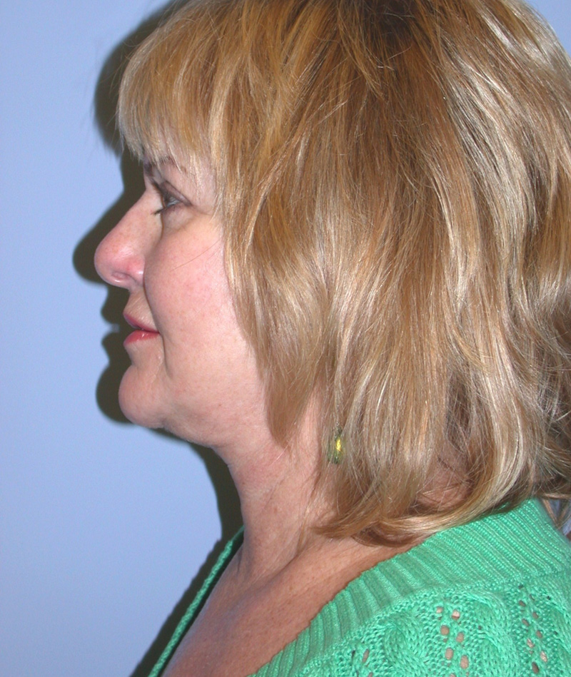 After Face Lift with Lip Filler by Dr. Bermudez in San Francisco