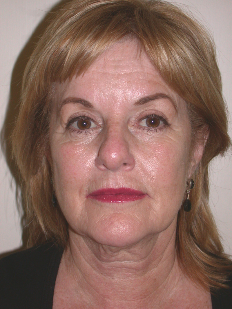 Before Face Lift with Lip Filler by Dr. Bermudez in San Francisco