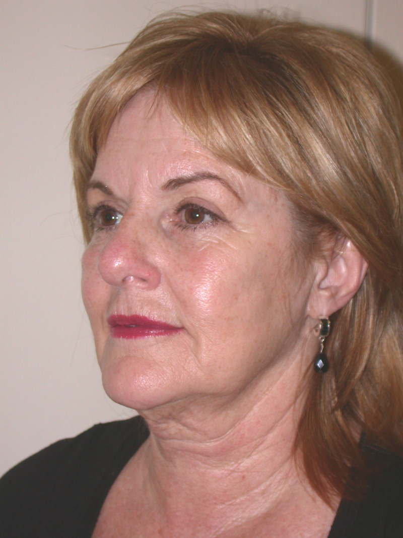 Before Face Lift with Lip Filler by Dr. Bermudez in San Francisco