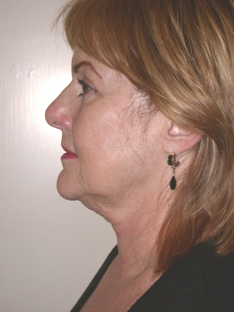 Before Face Lift with Lip Filler by Dr. Bermudez in San Francisco