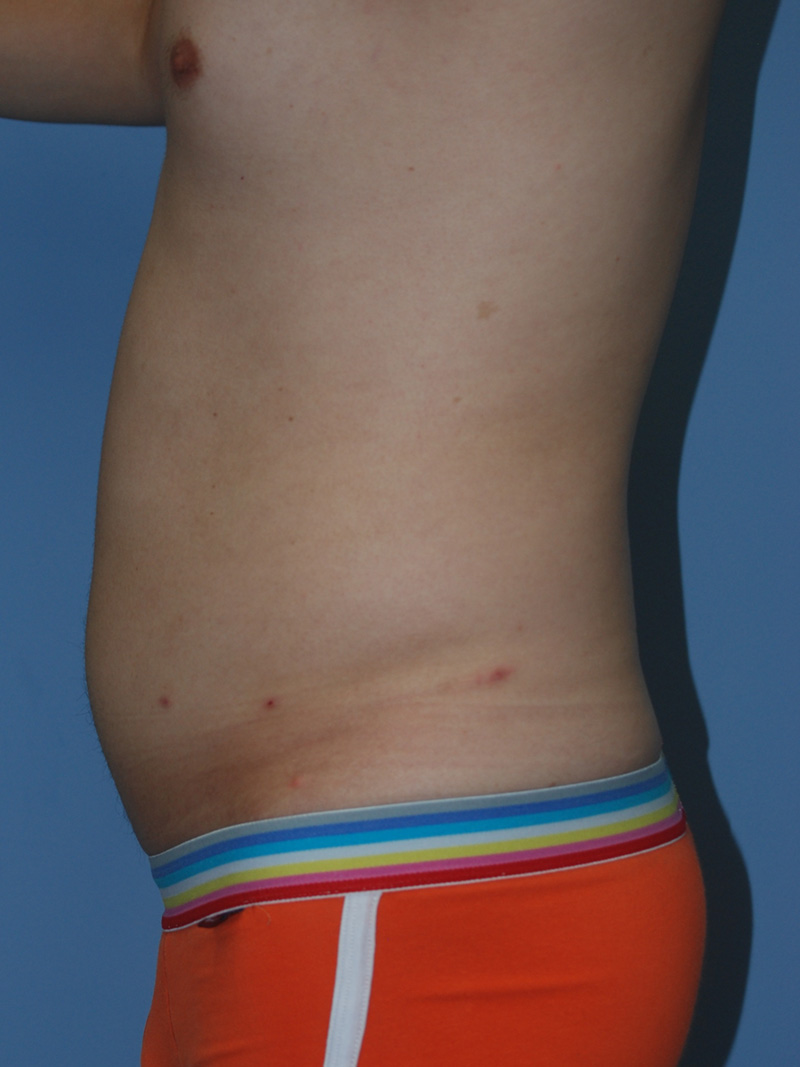 Before Liposuction by Dr. Bermudez