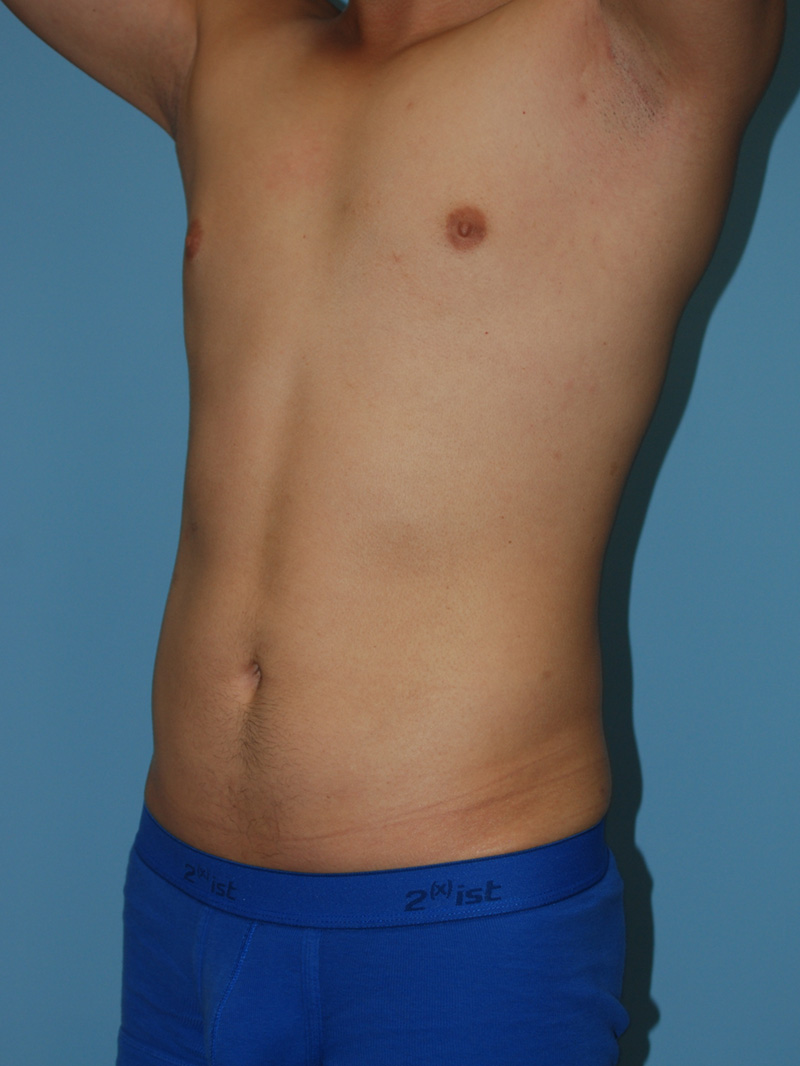 After Liposuction by Dr. Bermudez