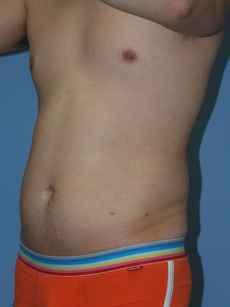 Before Liposuction by Dr. Bermudez