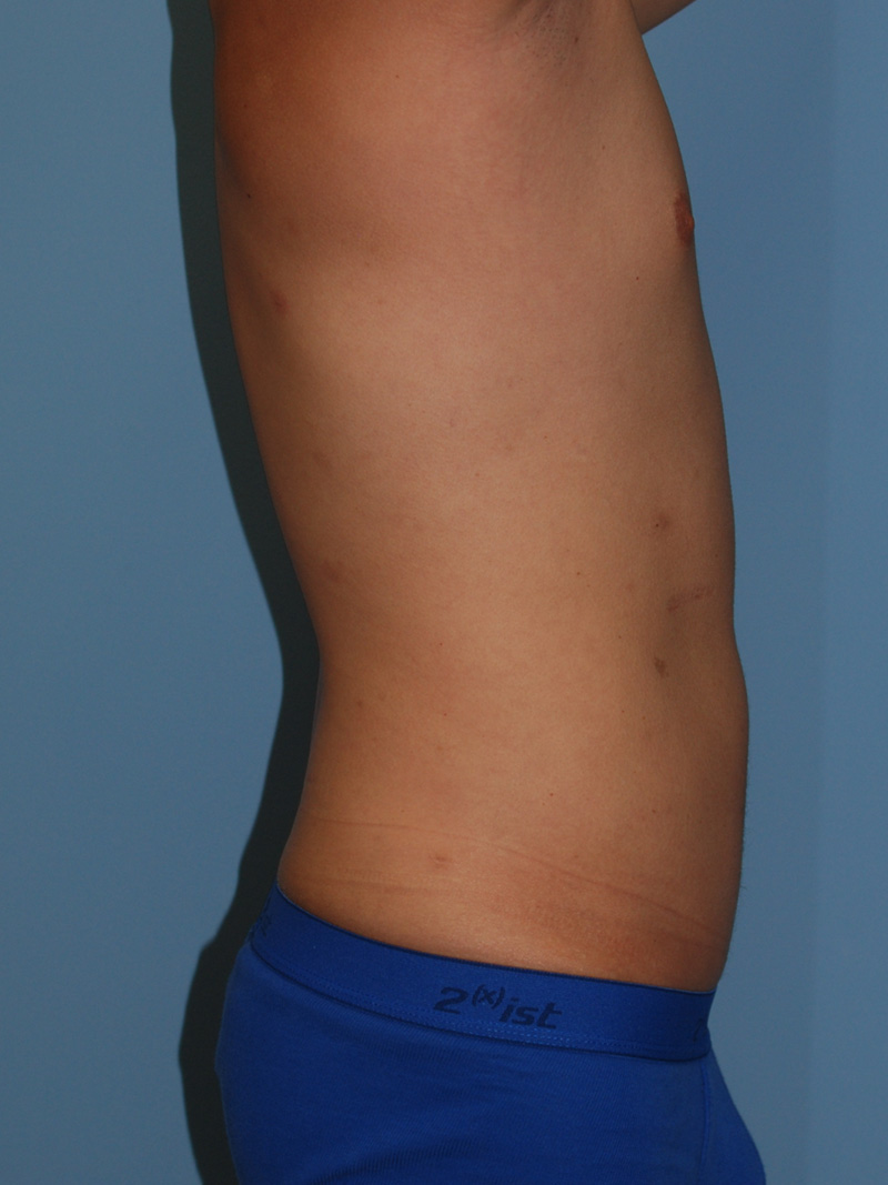 After Liposuction by Dr. Bermudez