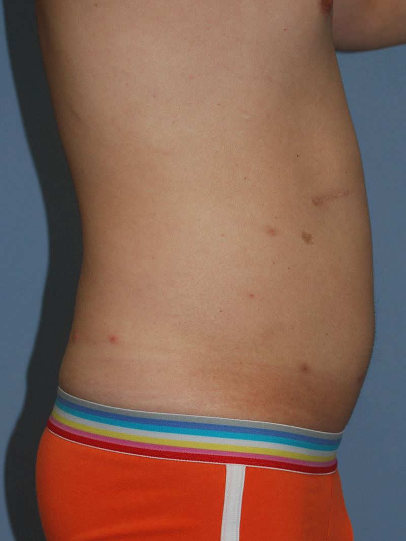 Before Liposuction by Dr. Bermudez