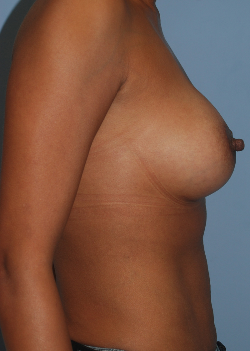 after breast implants