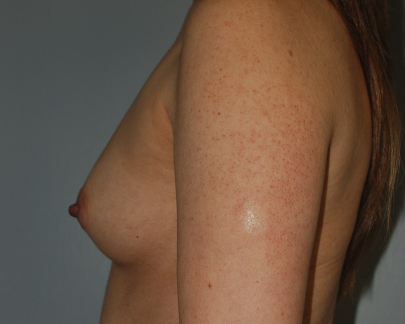 Before Breast Augmentation with Breast Implants by Dr. Bermudez