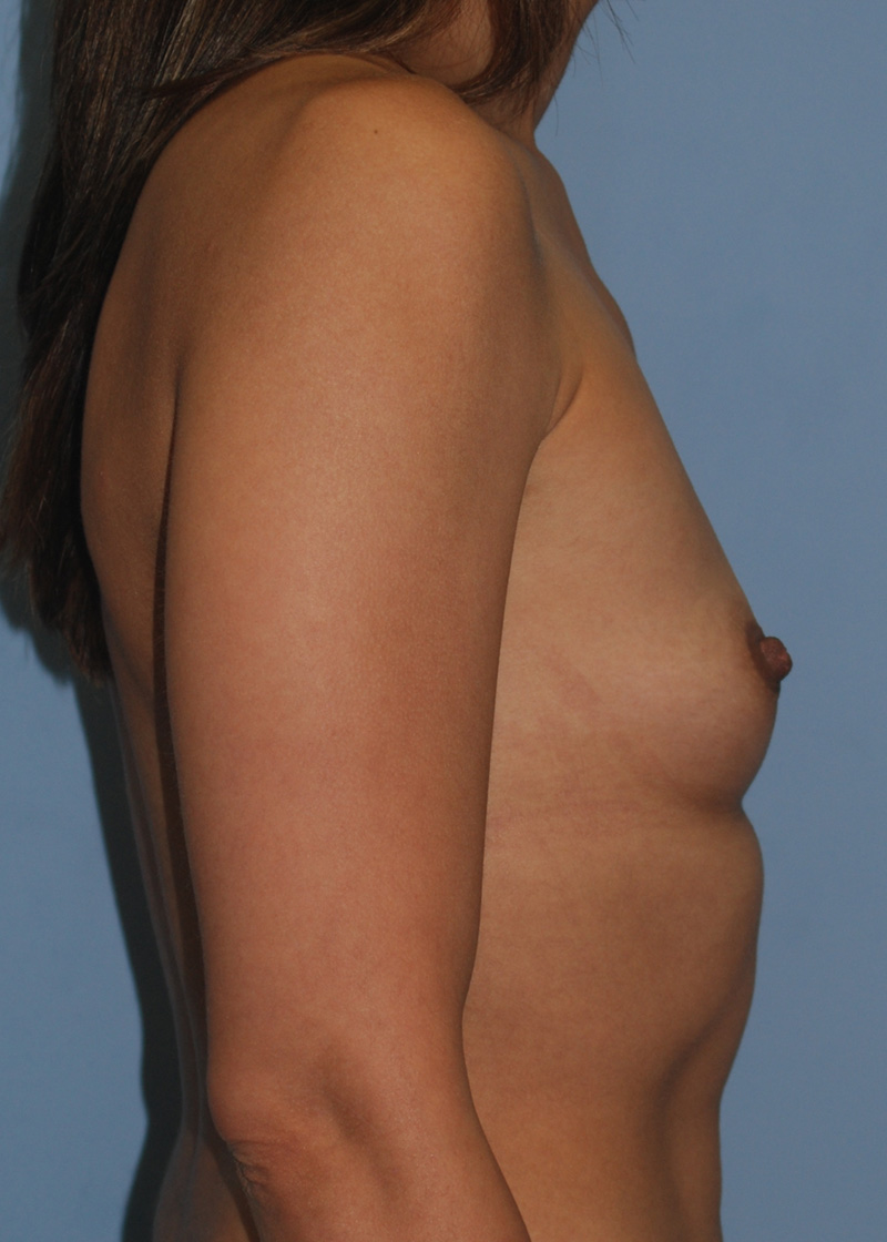 Before Breast Augmentation with Breast Implants by Dr. Bermudez