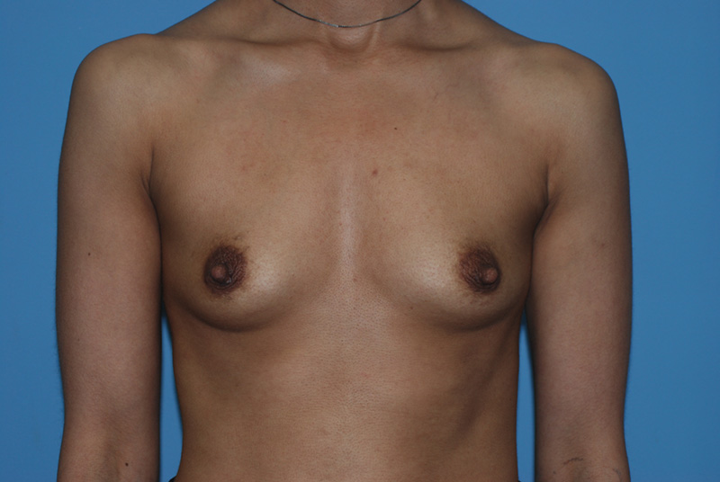 Before Breast Augmentation with Breast Implants by Dr. Bermudez