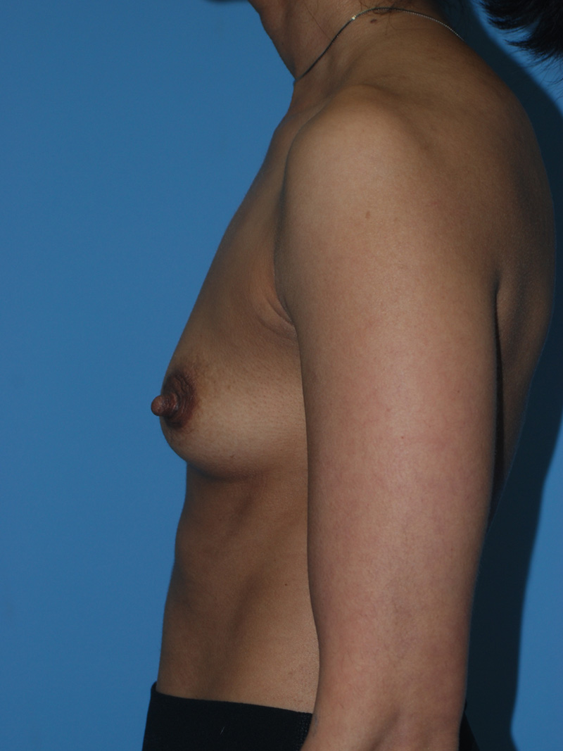 Before Breast Augmentation with Breast Implants by Dr. Bermudez