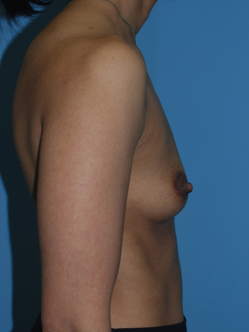 Before Breast Augmentation with Breast Implants by Dr. Bermudez