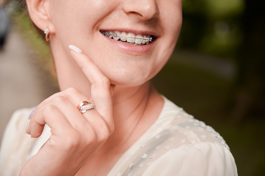 How to Get a Good Deal on Braces Under $1000