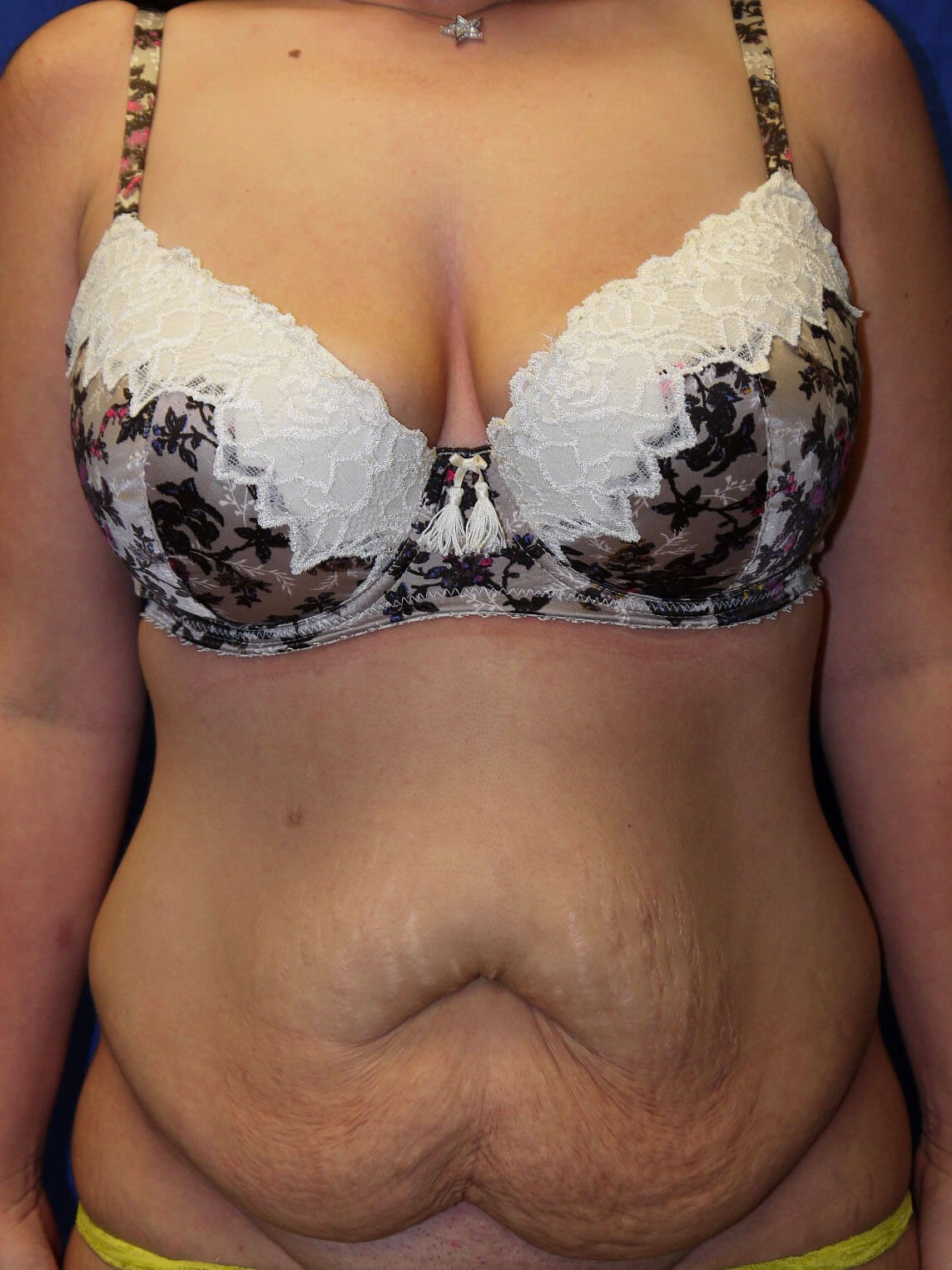 the mommy makeover on Tummy Tuck Before After Mommy Makeover Scottsdale Az