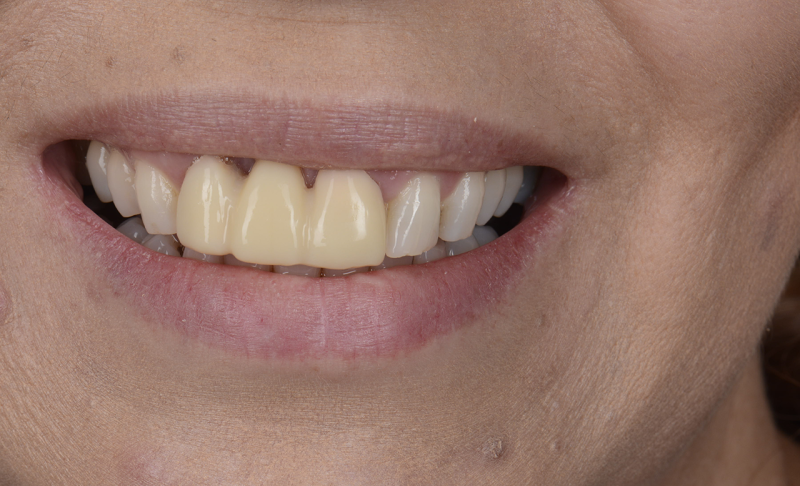 Teeth Bridge