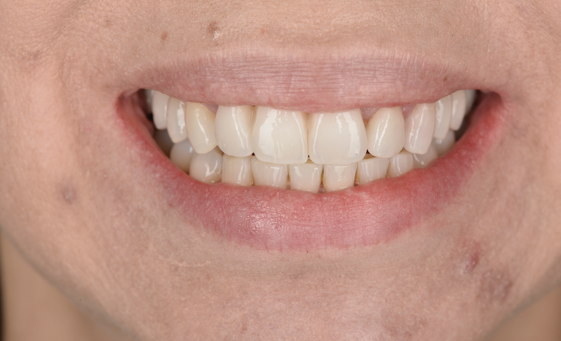 Teeth Bridge