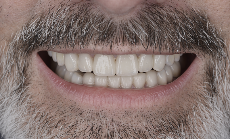 Full Mouth Reconstruction &ndash; Braces and Crowns
