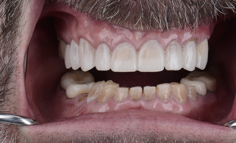 Full Mouth Reconstruction &ndash; Braces and Crowns