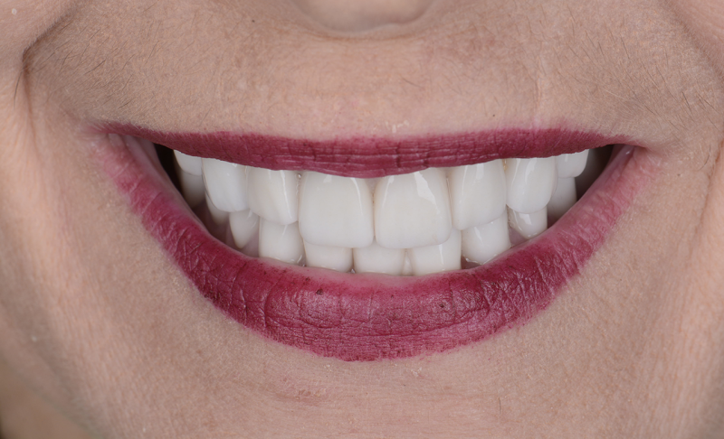 Full Mouth Rehabilitation &ndash;&nbsp; All Crowns