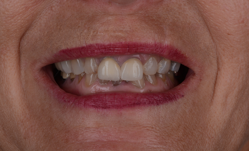 Full Mouth Rehabilitation &ndash;&nbsp; All Crowns