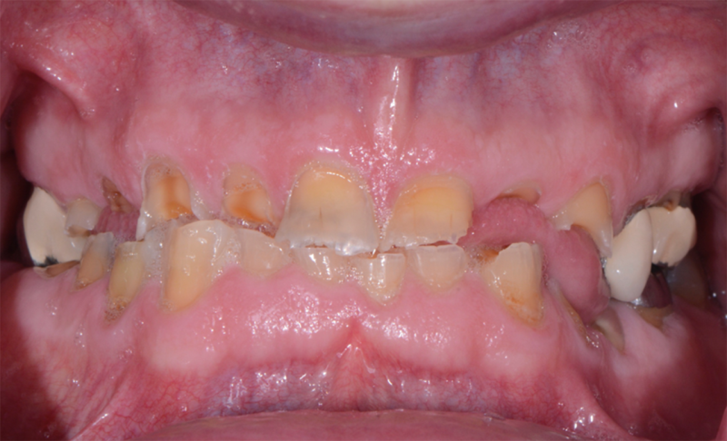 Full Mouth Rehabilitation
