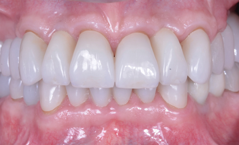Full Mouth Rehabilitation