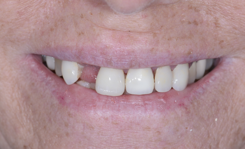 Smile Makeover &ndash; Single Implants and Veneers
