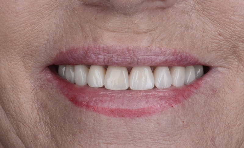 Smile Makeover &ndash; Single Implants and Veneers