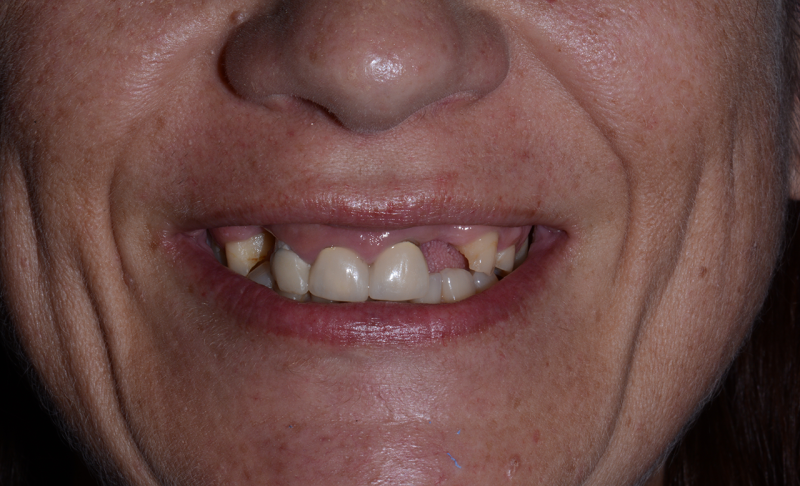 Smile Makeover &ndash; Crowns and Veneers